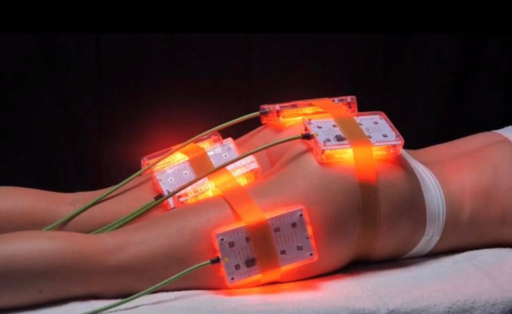 Ce tratamente de remodelare corporală să alegi? Sfatul specialistului 1 312278672 3155422194711252 7978510671136296956 n