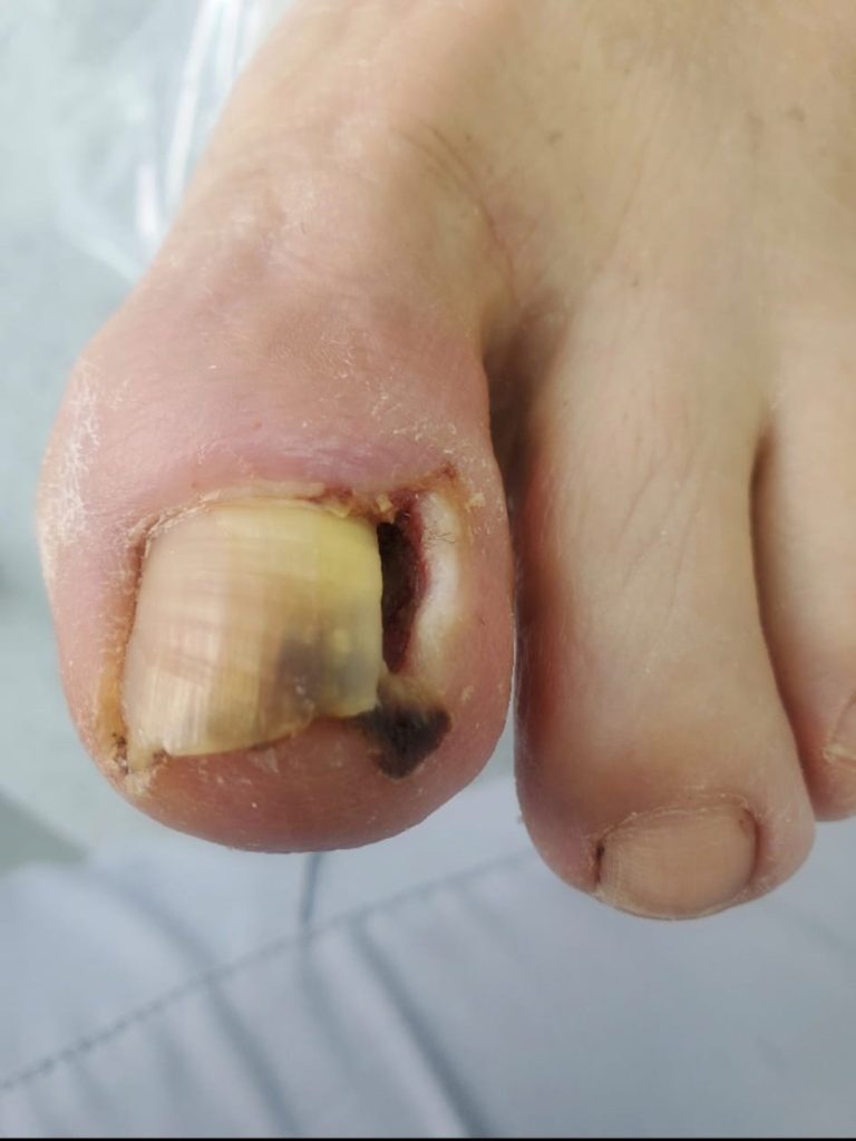 Tratament picior diabetic. Înainte și după